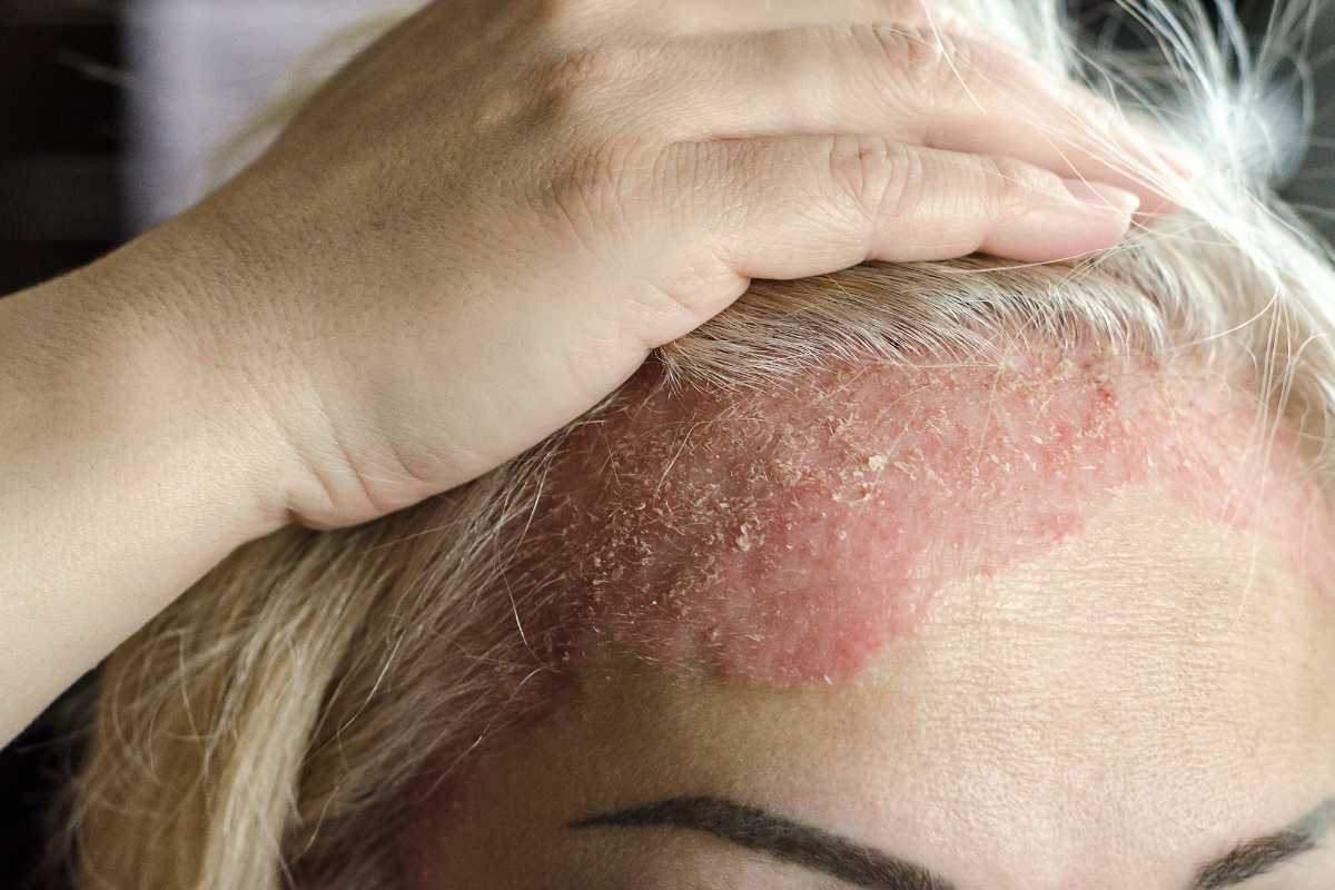 Can Scalp Eczema Cause Hair Loss