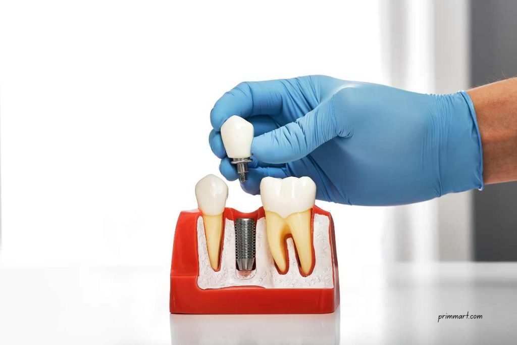 Are Dental Implants Worth It What to Know Before You Commit