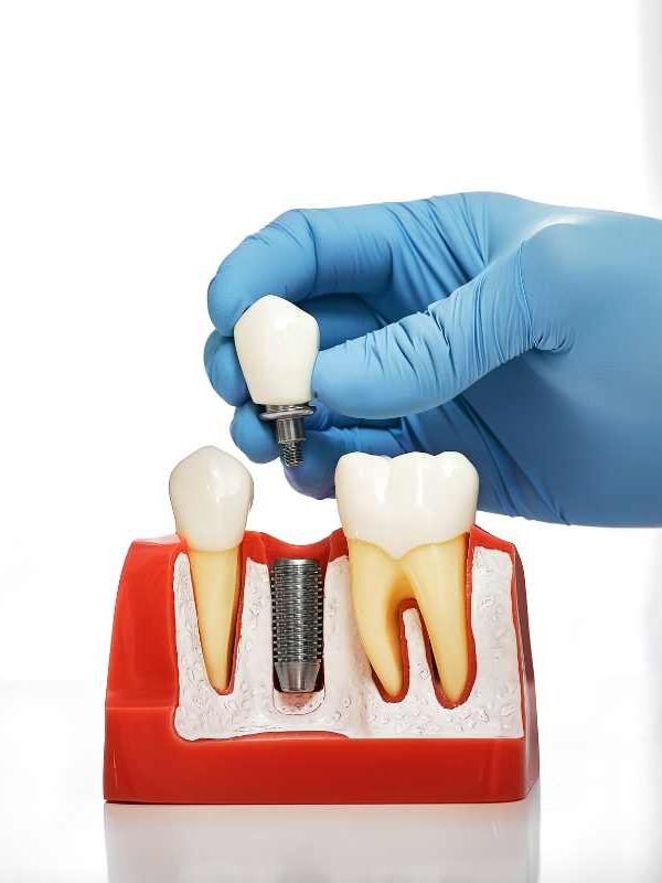 Are Dental Implants Worth It? What to Know Before You Commit